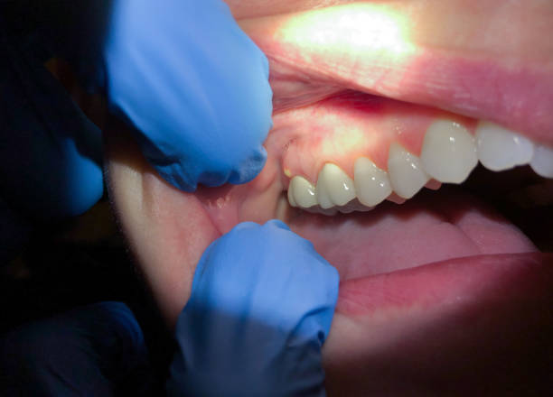 Best Emergency Dental Care for Abscessed Tooth in Standish, MI