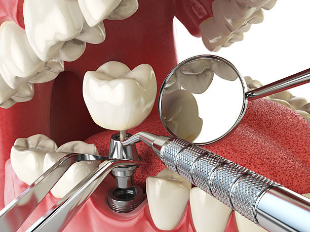 Best Emergency Dental Extractions in Standish, MI